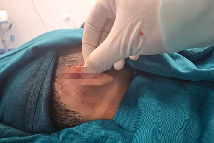 Một bệnh nhi bị chó cắn suýt mất tai. (Ảnh: Bệnh viện Nhi Hà Nội)