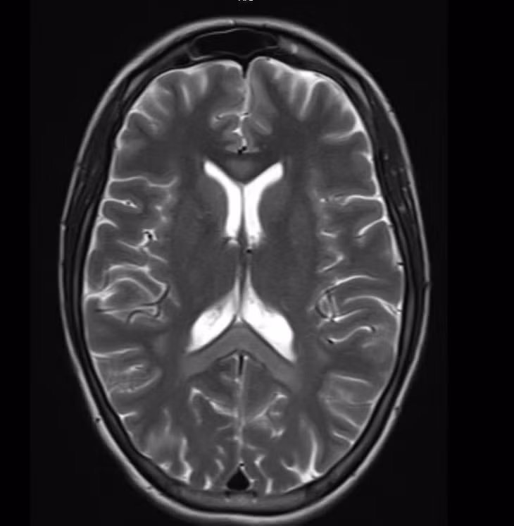 Hình ảnh chụp MRI sọ não bệnh nhân nữ bị tổn thương lan tỏa hai bán cầu và thể chai. Ảnh: BV