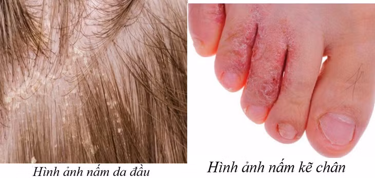 Lưu ý phòng bệnh nấm da trong mùa ẩm - Ảnh: BVCC