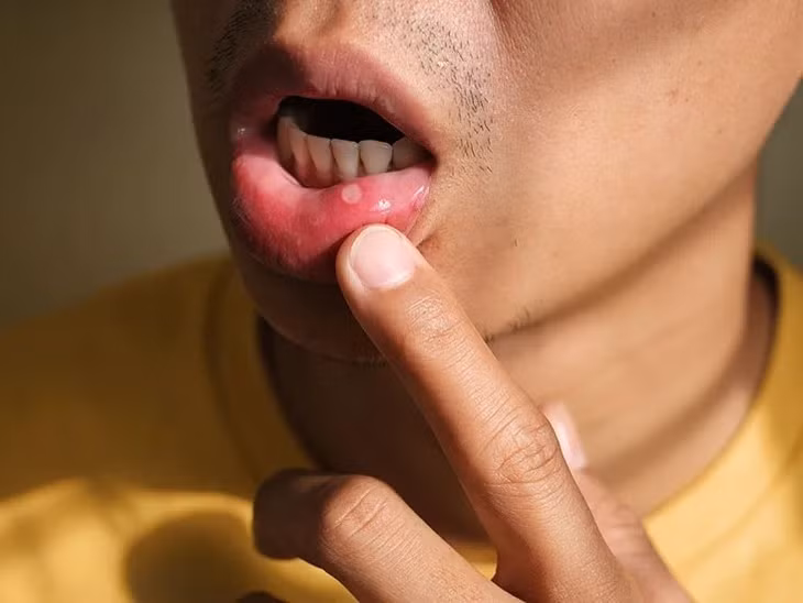 Nhiệt miệng tạo thành các vết loét khó chịu bên trong khoang miệng. Ảnh: Healthline.