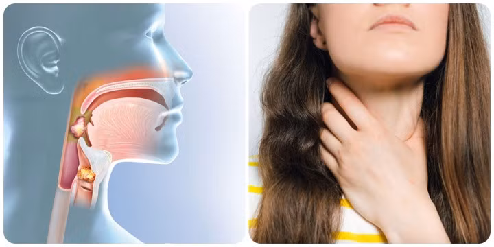 Dấu hiệu ung thư vòm họng giai đoạn đầu rất dễ bị nhầm với các bệnh thông thường khác.