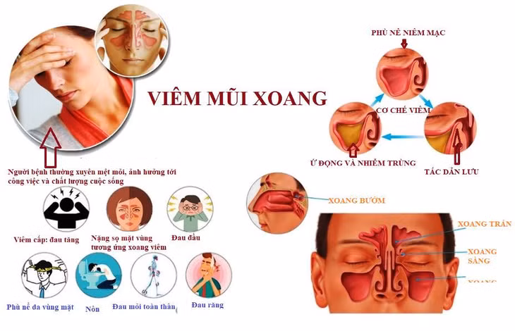 Viêm mũi xoang có thể khiến người bệnh thường xuyên mệt mỏi. Ảnh: BSCC