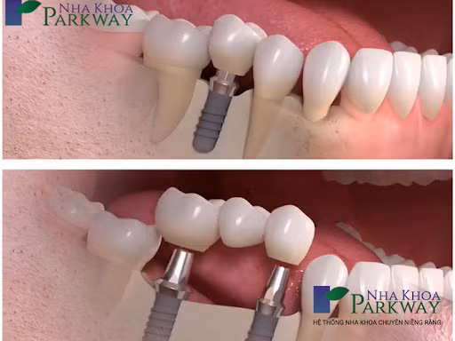 Trẻ em có trồng răng implant được không? ảnh 2