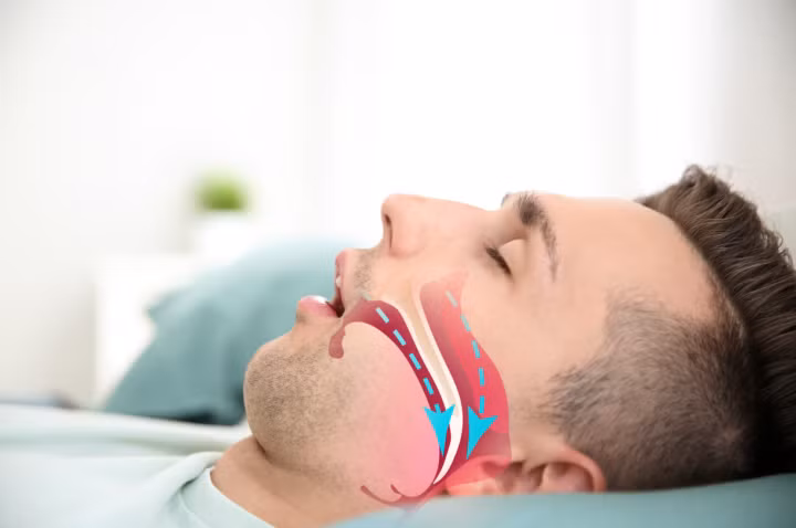 Điều nguy hiểm là không phải người ngủ ngáy nào cũng biết tình trạng nguy hiểm này. (Ảnh minh họa)