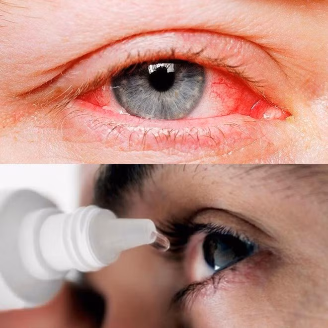 Biểu hiện của bệnh đau mắt đỏ. Đồ họa: Hương Giang