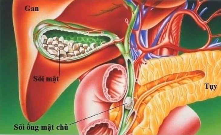Sỏi túi mật là bệnh lý phổ biến ở nữ giới hơn nam giới (Ảnh minh họa: BV).