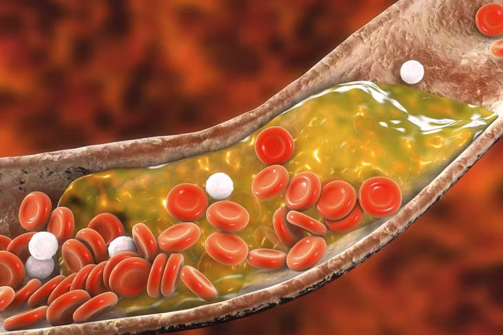 Cholesterol cao có thể gây xơ vữa động mạch, dẫn đến nhồi máu cơ tim và đột quỵ.