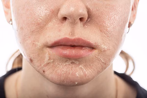 Peel da để loại bỏ lớp tế bào da chết bên ngoài và kích thích tăng sinh tế bào da mới, giúp da trắng mịn hơn.