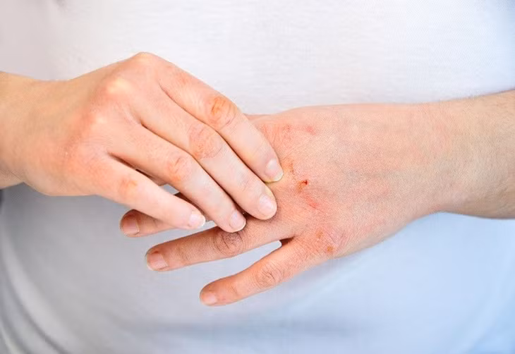 Mùa đông khiến da tay dễ bị khô, nứt nẻ, thậm chí bật máu...