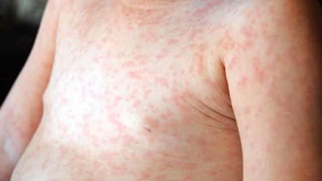Tùy vào các biểu hiện dị ứng khác nhau sẽ có cách chữa trị phù hợp.