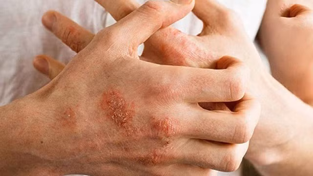 Dị ứng thời tiết có hai dạng là cấp tính và mạn tính.