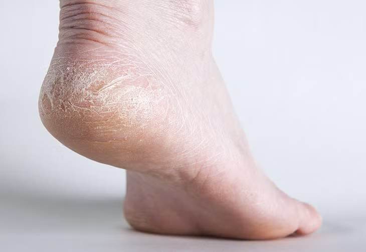 Da khô, nứt gót chân thường gặp nhiều hơn ở mùa lạnh.