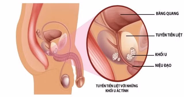 Hình ảnh ung thư tuyến tiền liệt.