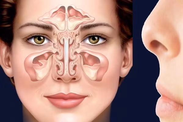 Viêm xoang trán là tình trạng niêm mạc xoang trán bị viêm, bít tắc lỗ thông xoang gây tình trạng tích tụ chất lỏng hoặc chất nhầy bên trong lòng xoang.