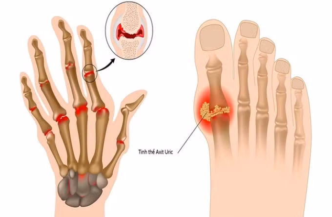 Nồng độ axit uric trong máu tăng cao là nguyên nhân hàng đầu gây ra bệnh gout.