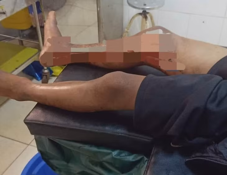 Chân cháu bé Y.N bị tẩm xăng đốt. Ảnh: T.X