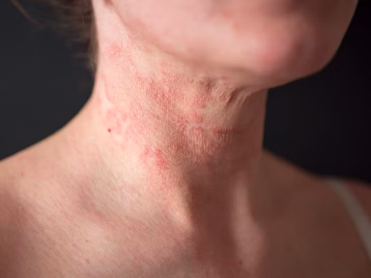 Một số chất bổ sung có thể cải thiện triệu chứng khó chịu của bệnh chàm. Ảnh minh họa.