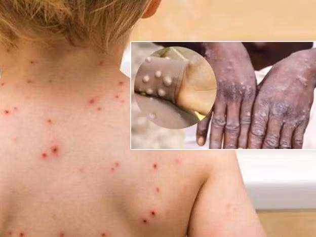 Tới thời điểm 18/7/2022, WHO không khuyến cáo việc tiêm vaccine phòng, chống bệnh đậu mùa khỉ rộng rãi do virus đậu mùa khỉ không dễ dàng lây lan