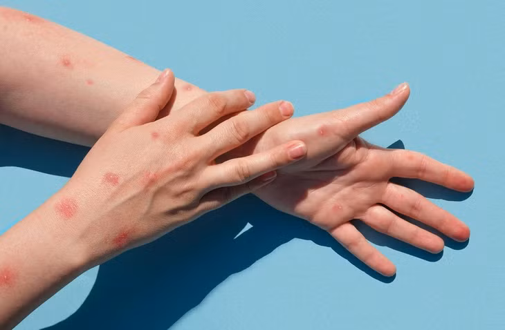 Thủy đậu và đầu mùa khỉ đều gây ra phát ban, mụn nước trên cơ thể. Ảnh minh họa: Freepik.