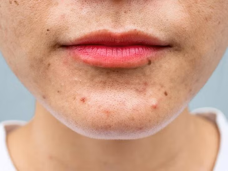 Các bệnh nhân da mụn cần tuân thủ đúng các bước chăm sóc để tránh diễn biến nặng. Ảnh minh họa: Healthline.