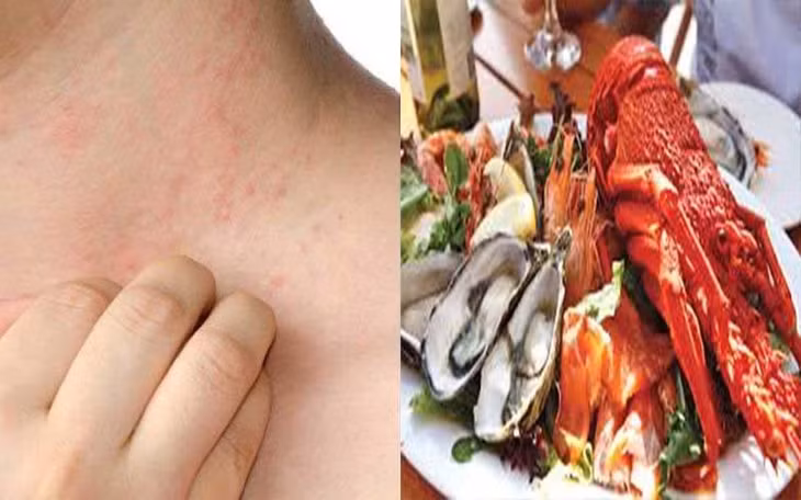 Một số người bị dị ứng với hải sản. Đồ hoạ: Mạnh Hoạt
