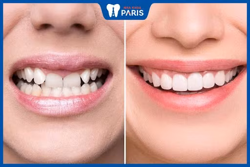 Chi phí bọc răng sứ sẽ phụ thuộc vào nhiều yếu tố khác nhau.