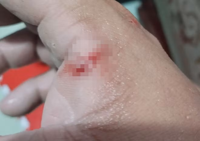 Người chồng bị chó cắn nhưng không đi chích ngừa. Ảnh: Danh Thành