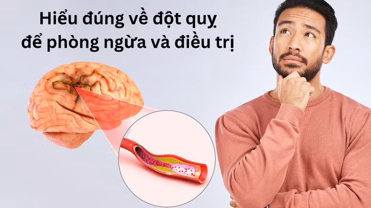 Những lầm tưởng về đột quỵ khiến bạn bỏ qua cơ hội vàng - Ảnh 2.