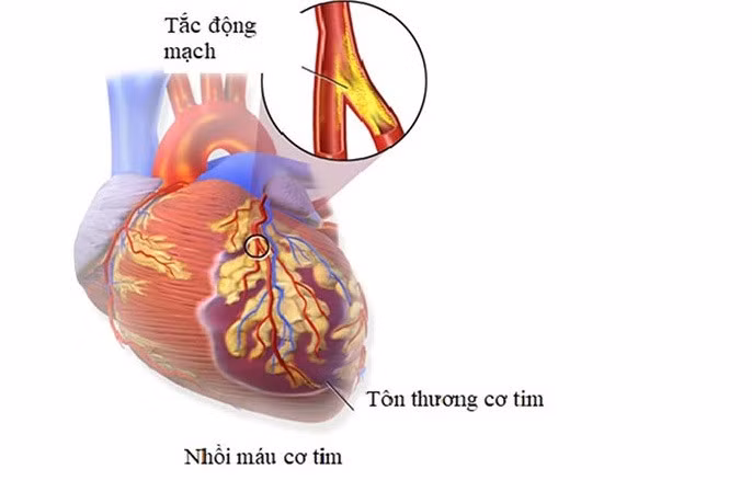 HÌnh ảnh tổn thương do nhồi máu cơ tim.