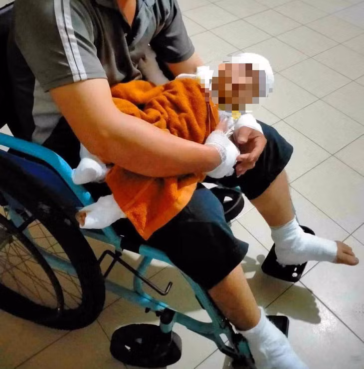 Bé 4 tháng tuổi bị phỏng độ II. Ảnh: NDCC