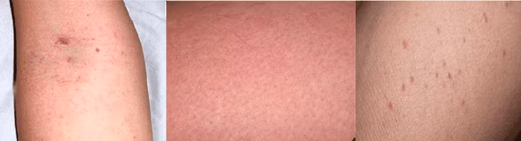 Dấu hiệu ngoài da phổ biến khi bệnh nhi được đưa đến viện (Ảnh: Lê Hiếu).