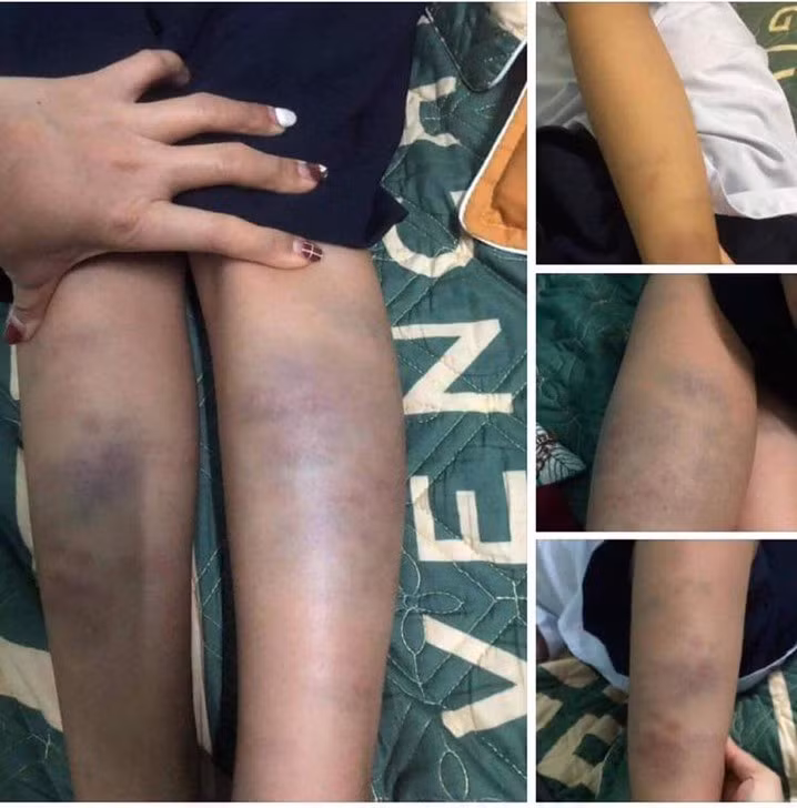 Một học sinh Đà Nẵng bị bầm tím chân khi ở trường về. Ảnh chụp màn hình