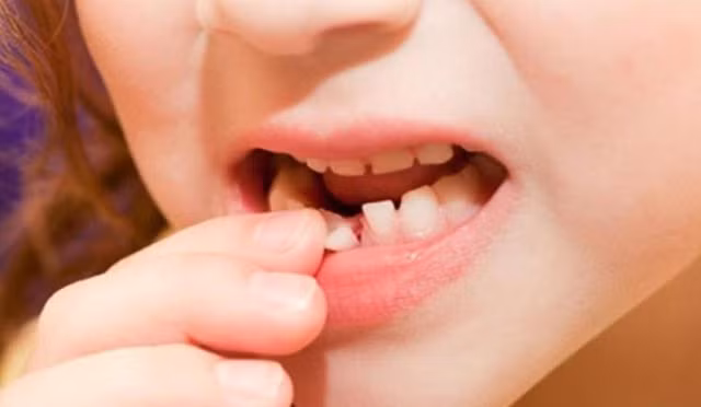 Răng sữa có vai trò quan trọng trong nhai nghiền thức ăn, thẩm mỹ và định hướng cho răng vĩnh viễn.