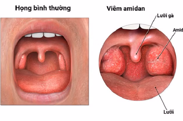 Viêm amidan là tình trạng viêm cấp gây sung huyết thường gặp ở trẻ trên 5 tuổi.