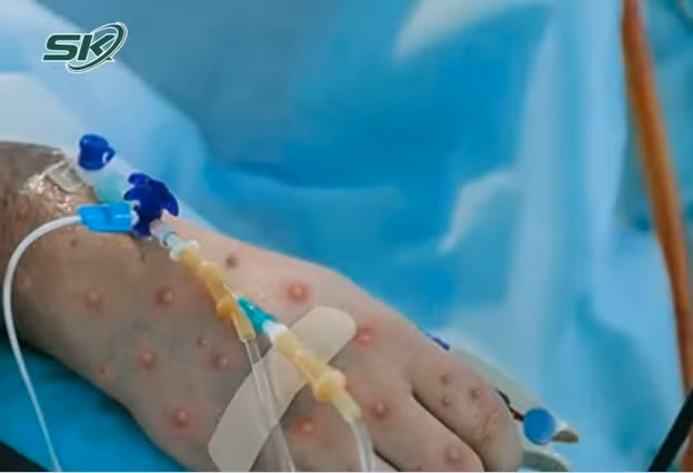 Bộ Y tế chiều 3/10 đã thông tin về ca mắc đậu mùa khỉ đầu tiên tại Việt Nam là nữ, 35 tuổi, thường trú tại TP HCM khởi phát bệnh khi đang du lịch tại Dubai... Trước đó, kết quả xét nghiệm giải trình tự gen khẳng định nữ bệnh nhân mắc đậu mùa khỉ chủng Monkeypox virus thuộc clade IIb. (Ảnh:minh hoạ)