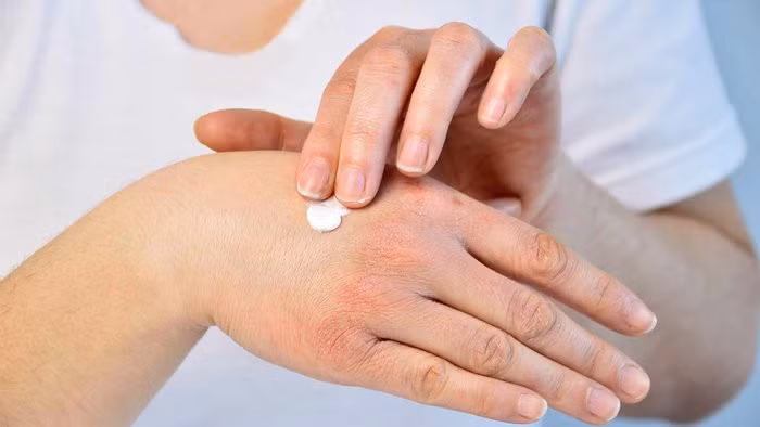 Người bị vảy nến cần giữ độ ẩm cho da, tránh để da quá khô sẽ gây bùng phát bệnh (Ảnh: Internet)