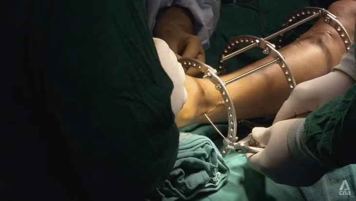 Phẫu thuật kéo dài chi sử dụng một phương pháp được phát triển lần đầu tiên vào năm 1951. Ảnh: CNA