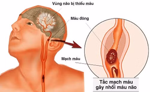Cục máu đông, xơ vữa động mạch là một trong những nguyên nhân gây thiếu máu não.