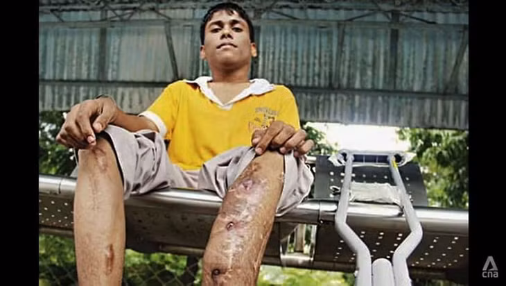 Chân của Ajay Patel bị nhiễm trùng sau ca phẫu thuật kéo chi. Ảnh: CNA