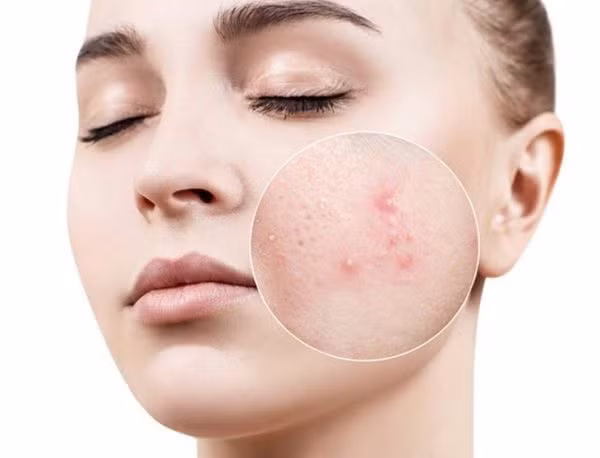 5 loại nguyên liệu hàng đầu có khả năng đánh bay mụn hiệu quả - Ảnh 1.