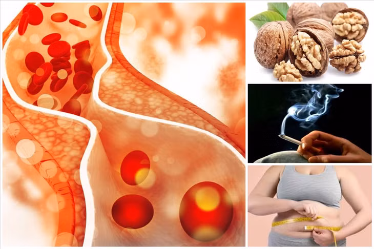 Tắc nghẽn mạch máu là bệnh lý nguy hiểm ảnh hưởng nghiêm trọng đến sức khỏe và có thể gây tử vong cho bạn.