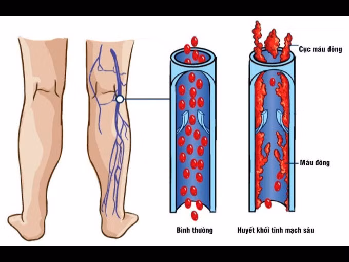 Mô phỏng thuyên tắc tĩnh mạch chân do cục máu đông. Ảnh: Amar Health