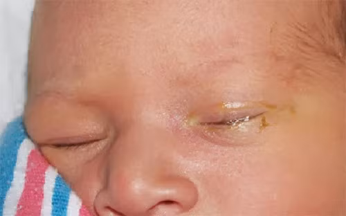 Hình ảnh bé bị tắc lệ đạo mắt trái