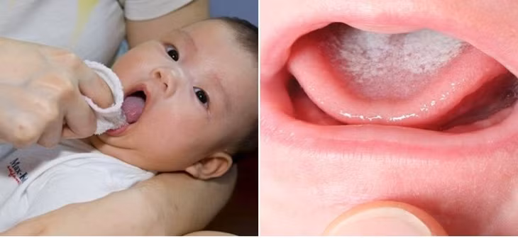 Việc vệ sinh đúng cách khi bé bị tưa miệng là vô cùng quan trọng.