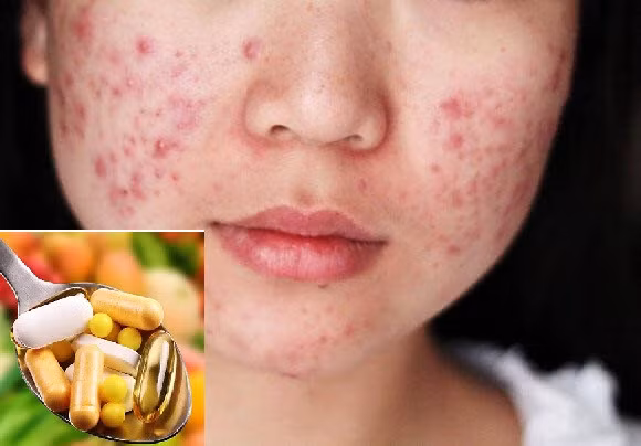 Chỉ sử dụng kháng sinh đường uống khi thực sự cần thiết.