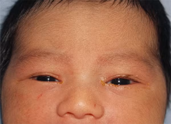 Đây là một trường hợp tắc lệ đạo hai bên. Cả hai mắt đều bị ảnh hưởng, mặc dù phía mắt trái có nhiều chất tiết hơn mắt phải.