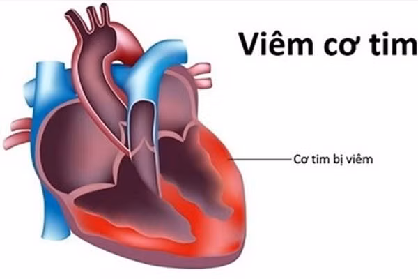 Viêm cơ tim sau tiêm vaccine COVID-19: Chẩn đoán, điều trị thế nào? ảnh 1 Viêm cơ tim sau tiêm vaccine COVID-19: Chẩn đoán, điều trị thế nào? ảnh 1