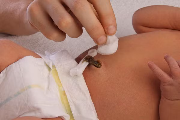 Đối với việc chăm sóc rốn ở trẻ sơ sinh cần chú ý.