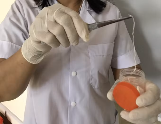 Giun rồng được bác sỹ Trung tâm Kiểm soát bệnh tật lấy ra từ đùi trái của bệnh nhân. Ảnh: Sở Y tế Yên Bái