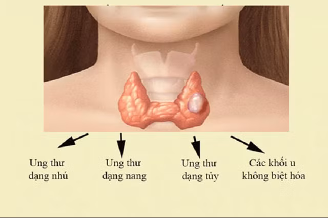 Các thể của ung thư tuyến giáp